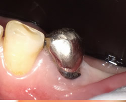 左下第一小臼歯 コンポジットレジンクラウン治療前