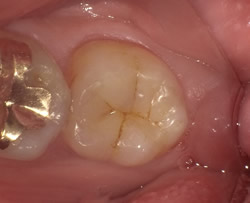左下第二大臼歯 コンポジットレジン単純治療後