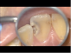 根管治療からCR充填までのながれ　～上顎前歯～