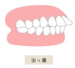 歯並び　出っ歯