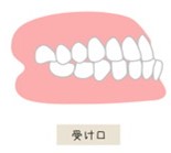 歯並び　受け口
