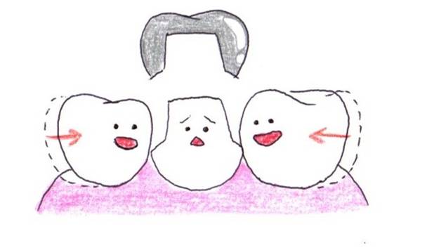詰め物が入らない