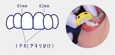 マウスピース