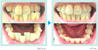 マウスピース矯正