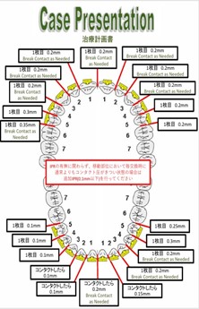 マウスピース矯正
