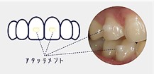 マウスピース矯正