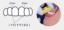 マウスピース矯正