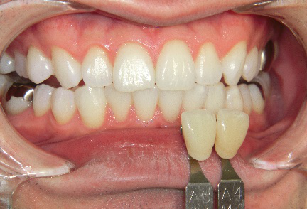 ホワイトニング　施術後