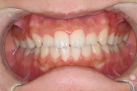 ホワイトニング　施術前