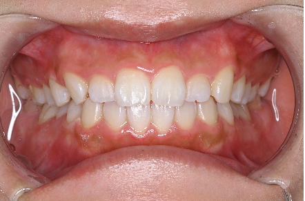 ホワイトニング　施術後