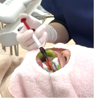 ホワイトニングの施術中