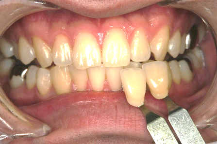 ホワイトニング　施術前